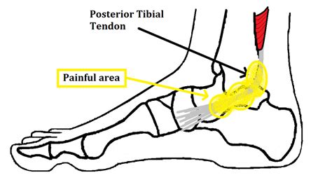 special test for posterior tibialis tear|right posterior tibial tendon.